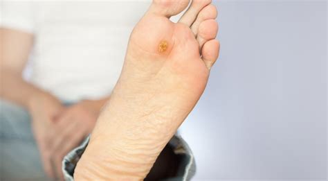 How To Deal With Diabetic Foot Ulcer