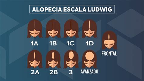 ¿qué Es La Alopecia Androgénica Femenina Causas Síntomas Y