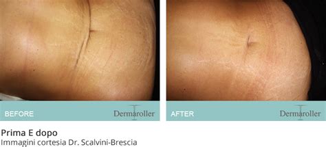 The common size for a dermaroller is 0.25 and what those needles do is make a little microchannel into the skin so the product or serum will penetrate deeper into the skin, markarian. Dermaroller