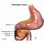 Pancreatic Cancer  Oncology Medbullets Step 2/3