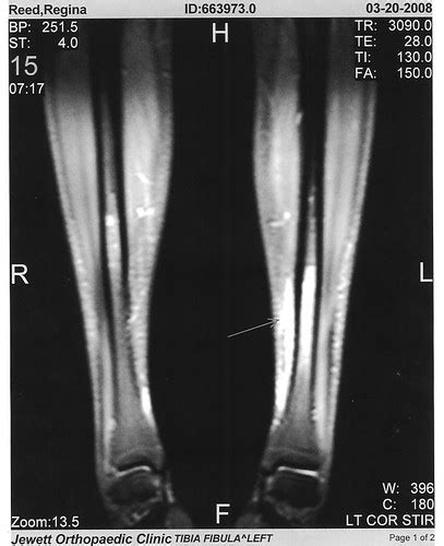 Stress Fracture Ginas Mri From March 2008 Rob Reed Flickr