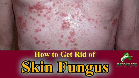 How To Get Rid Of Skin Fungus Get Pure And Clean Skin Fungus Free