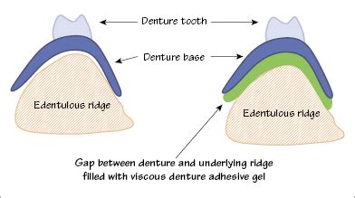 The difference in strength between cohesive forces and adhesive forces determine the behavior of a liquid in contact with a solid surface. 30: Denture adhesives | Pocket Dentistry