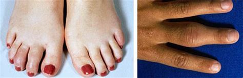Swelling Of The Fingers And Toes From Juvenile Arthritis Health Magazine