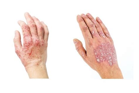 Psoriasis Vs Eczema What Is The Difference Eczema Psoriasis