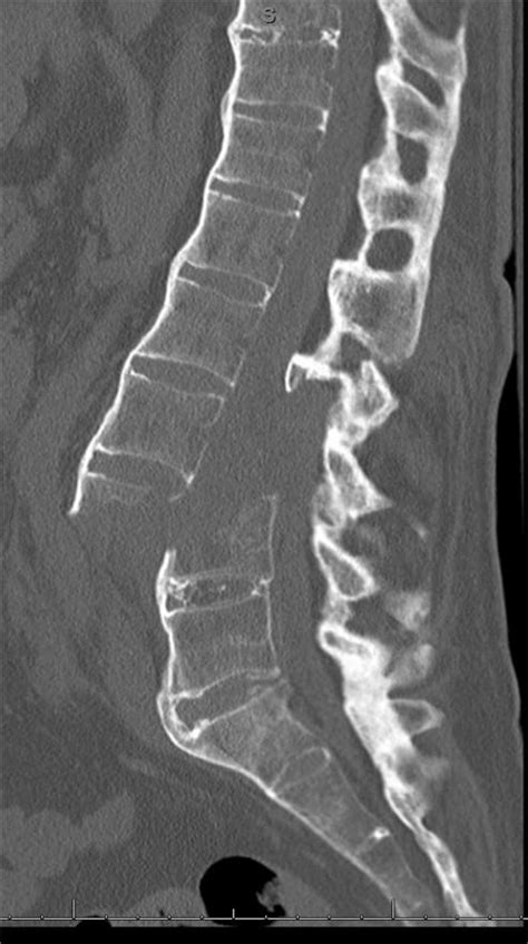 Transverse Vertebral Fracture