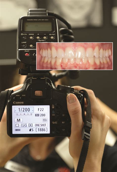 Getting The Perfect Photo Orthodontic Products