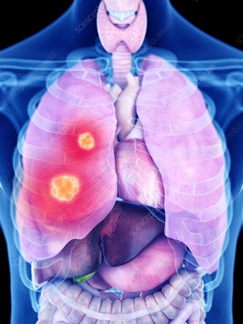 Illustration Of Lung Cancer Stock Image F0236853 Science Photo