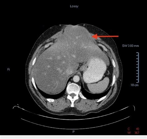Ct Abdomen Axial View Showing Herniation Of The Left Hepatic Lobe