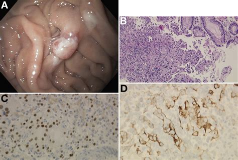 Metastatic Renal Cell Carcinoma Presenting As A Solitary Gastric Polyp
