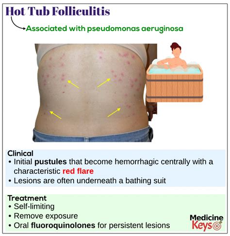 Hot Tub Folliculitis Medicine Keys For Mrcps