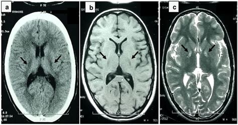 Brain Mr Sequences Of The Proband Of The Study Black Arrows On The