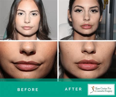 Lip Plastic Surgery Before And Afters Kass Center For Cosmetic Surgery