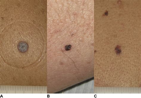 Three Dermoscopic Signs Of Growth Of Pigmented Lesions Journal Of The