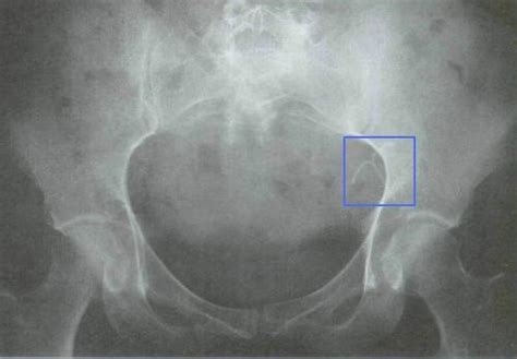 The iud is inserted into the uterus. Mirena Migration and Perforation | Dangerous Drugs ...
