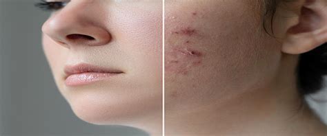 Acne Treatment Clinic Dubai Laser Scar Removal Dubai