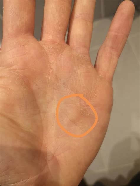 Lump On Palm Makes Snatches Very Uncomfortable Kettlebell