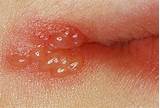 Herpes Medications List Pictures