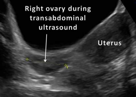 Kidneys are located retroperitoneally on the posterior abdominal wall on either side of vertebral column. Pelvic / Gynaecologic Ultrasound | Advanced Women's Imaging