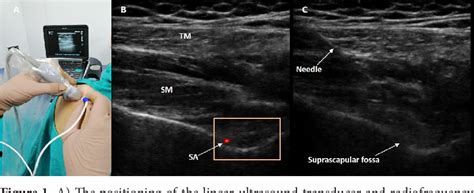 Figure 1 From Ultrasound Guided Pulsed Radiofrequency Neuromodulation