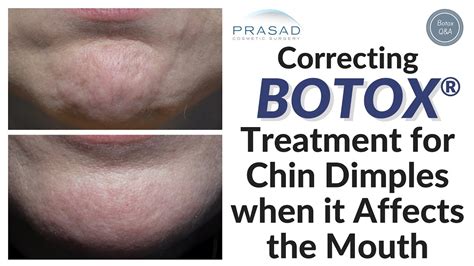 How Placement Of Botox In The Chin May Affect The Lips And Mouth Youtube