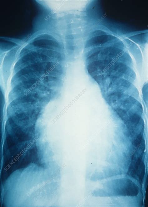 Enlarged Heart X Ray Stock Image C0237552 Science Photo Library