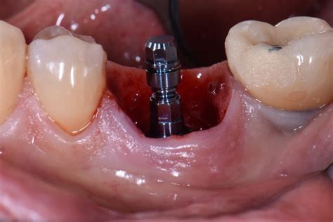 Considerations For Immediate Implant Placement Iti Blog