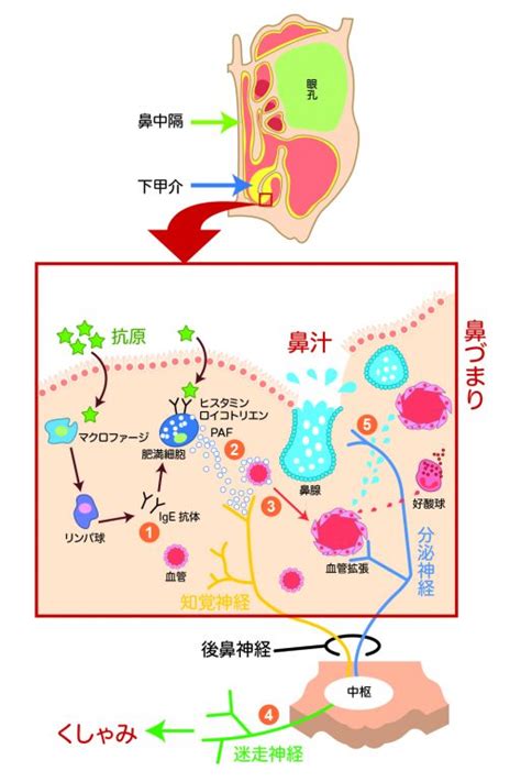 アレルギー性鼻炎・副鼻腔炎（蓄膿症）｜西宮市・芦屋市の ...