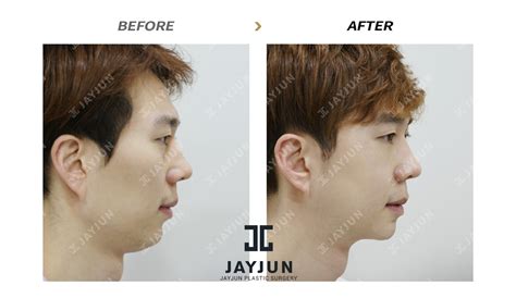 How Much Does It Cost For Nose Plastic Surgery In Korea