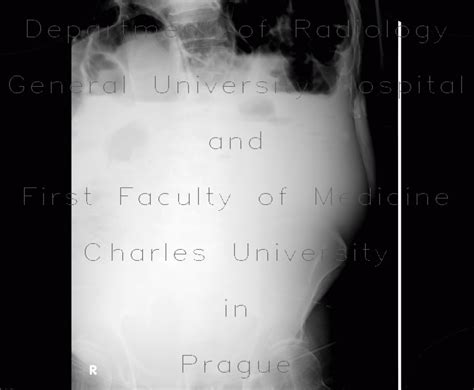 Radiology Case Ileus Small Bowel Obstruction Sbo