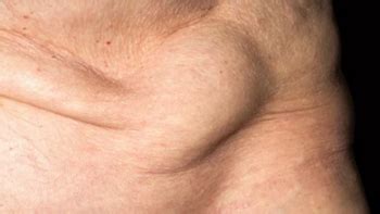What Is Inguinal Hernia Causes Surgery Recovery