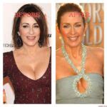 Patricia Heaton Plastic Surgery Photos Before After Surgery4