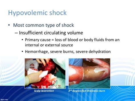Haemorrhagic Shock