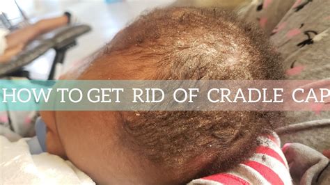 How To Get Rid Of Cradle Cap Step By Step Tutorial Youtube