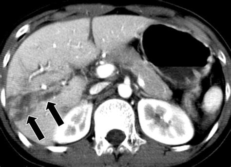 Ct In Blunt Liver Trauma Radiographics