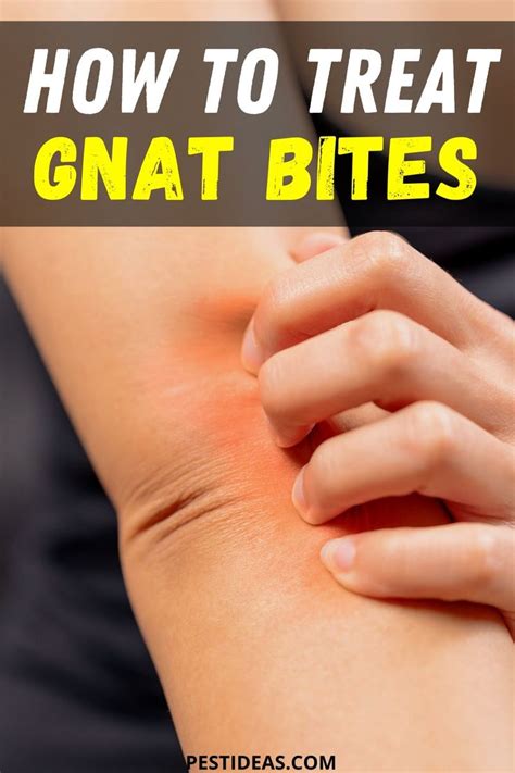 How To Treat Gnat Bites In 2020 Gnat Bites How To Get Rid Of Gnats