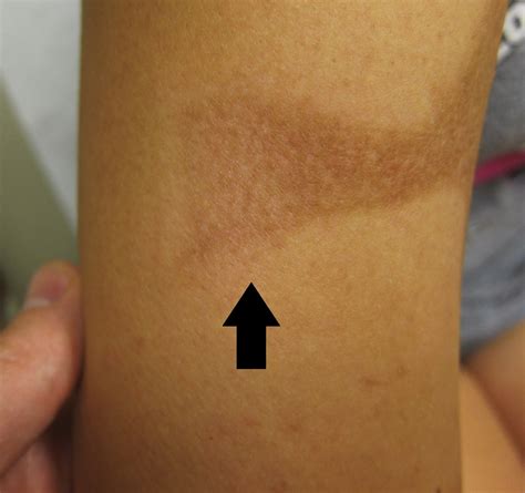 Hyperpigmented Burn Scar Improved With A Fractionated 1550 Nm Non