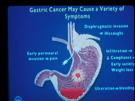 Carcinoma, leiomyosarcoma, fibrosarcoma and osteosarcoma. Gastric Cancer - Cancer Therapy Advisor