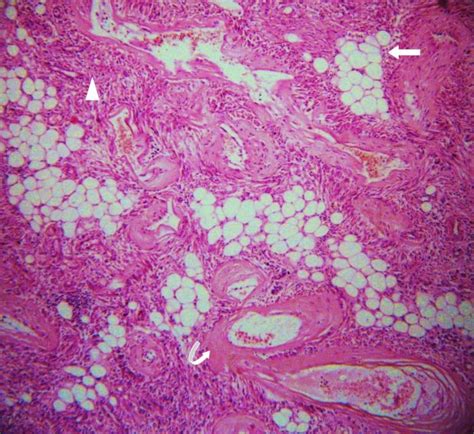 D 42 Yr Female With Right Renal Angiomyolipoma Histopathology With H