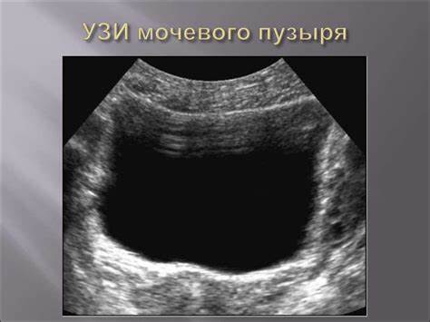 Диета при узи мочевого пузыря Узи Мочевого Пузыря Фото — Картинки фотографии Узи Мочевого Пузыря Фото — Картинки фотографии Диета при узи мочевого пузыря