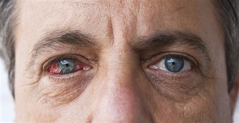 What Is Diabetic Eye Disease Diabeteswalls