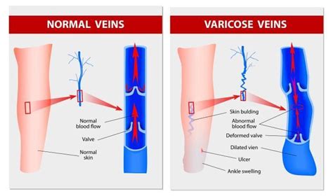 Chronic Venous Insufficiency C V I Bakersfield CA Heart Vascular And Leg Center
