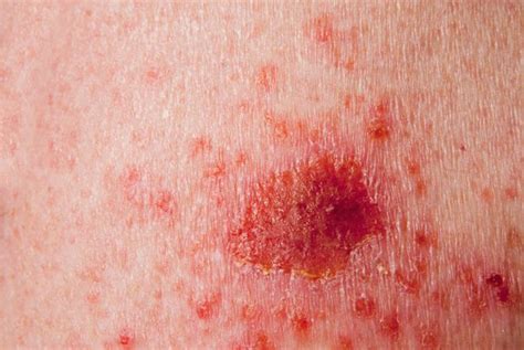 9 Symptoms And Treatments Of Actinic Keratosis Facty Health