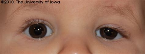 Clinical Course Congenital Ptosis Ophthalmology The