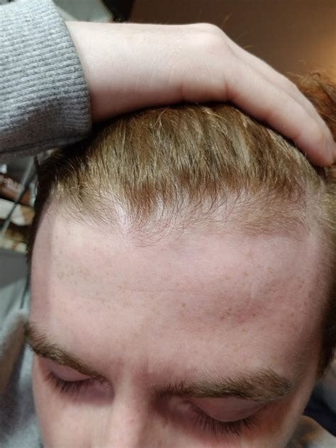 Balding Or New Hair Growth Its Hard For Me To Tell Because I Never