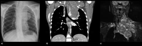 Imaging Of A Mediastinal Mass In A Child With Hodgkin S Lymphoma A