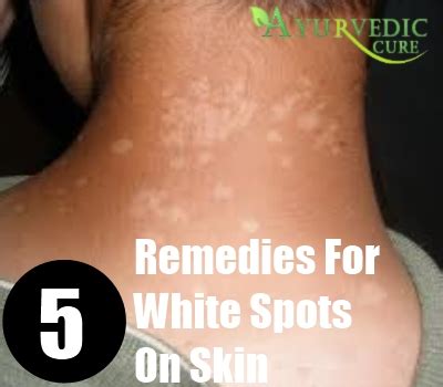 This condition might be because of various skin conditions, the most common which is vitiligo. White Spots On Skin Home Remedies, Treatments And Cures ...