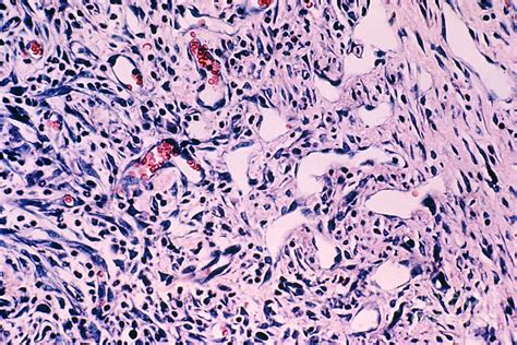 Kaposis Sarcoma Photograph By Science Source