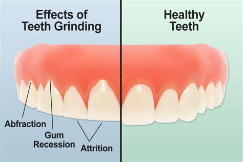 How Bruxism Impacts Your Oral Health Causes Symptoms And Treatments