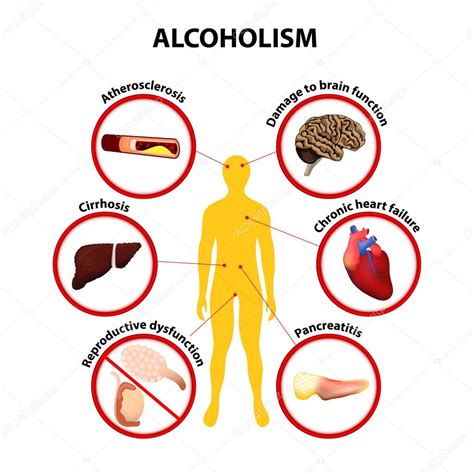 Alcoholismo infografía Stock Vector by edesignua